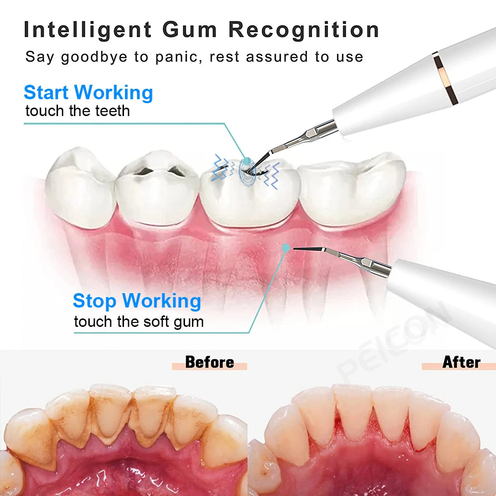 Ultrasonic Dental Teeth Plaque Remover & Cleaner – Sonic Tartar Removal Tool