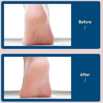 Electric Foot Skin Remover & Callus Sander